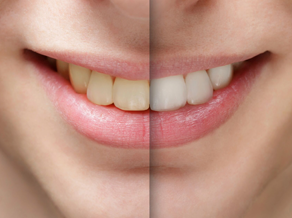 Teeth Whitening Treatment