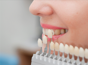 Veneers in Fort Myers